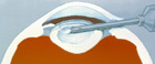 Phacoemulsification or phaco technique
