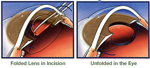 Foldable Lens in Eye