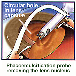 Phacoelmulsification technique