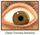 Clear Cornea Incision