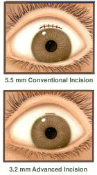 5.5 mm and 3.2 mm Incisions